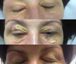 Ət xallarının müalicəsi 